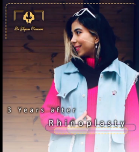 rhinoplasty-12