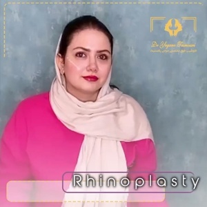 rhinoplasty-7