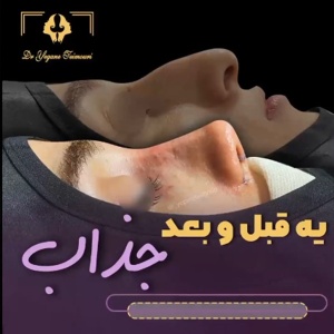 rhinoplasty18