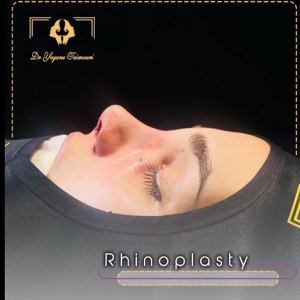 rhinoplasty22
