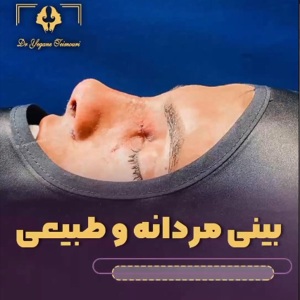 rhinoplasty24