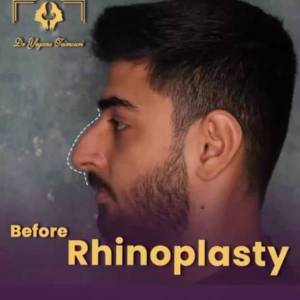 rhinoplasty27