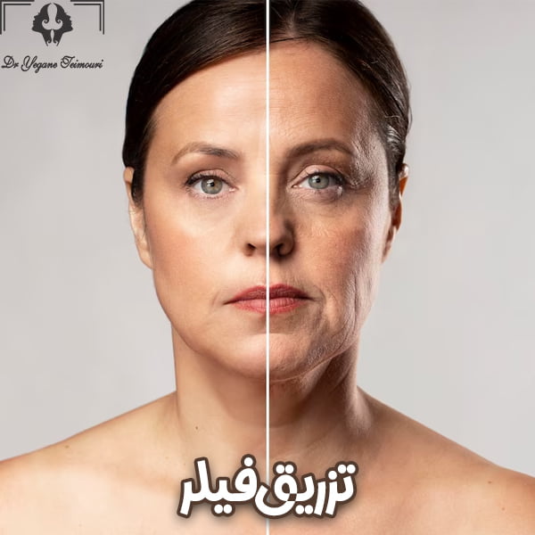 تزریق فیلر-دکتر یگانه تیموری