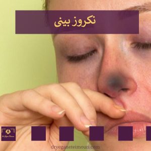نکروز بینی بعد از جراحی _ دکتر یگانه تیموری