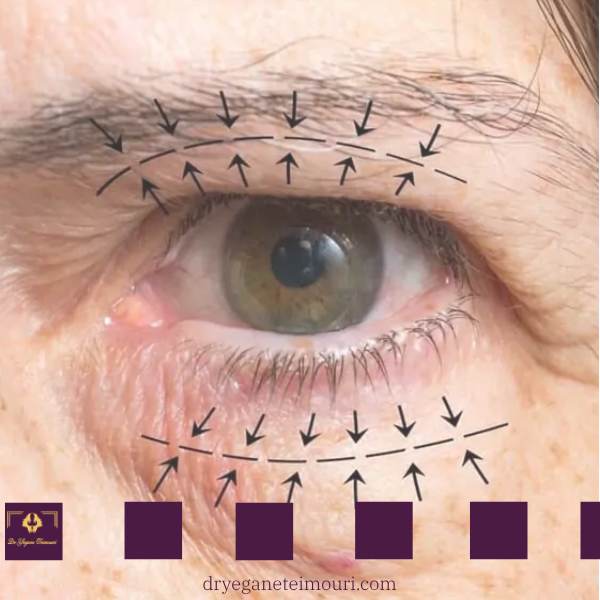 بلفاروپلاستی چشم