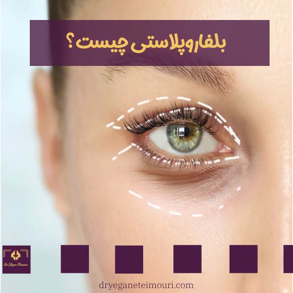 بلفاروپلاستی پلک