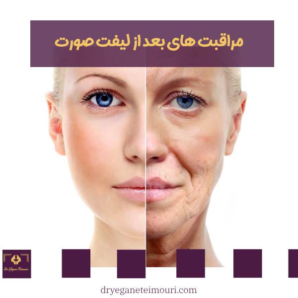مراقبت های بعد از لیفت صورت