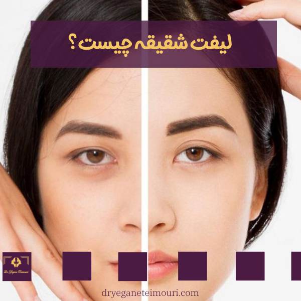 کشیدن شقیقه