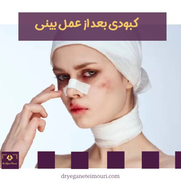 کبودی بعد از عمل بینی