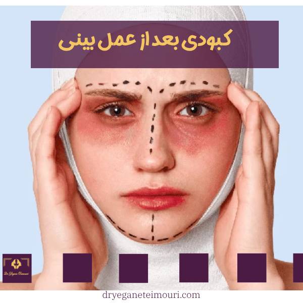 کبودی بعد از عمل بینی
