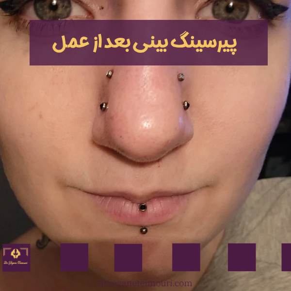 پیرسینگ بعد از عمل بینی