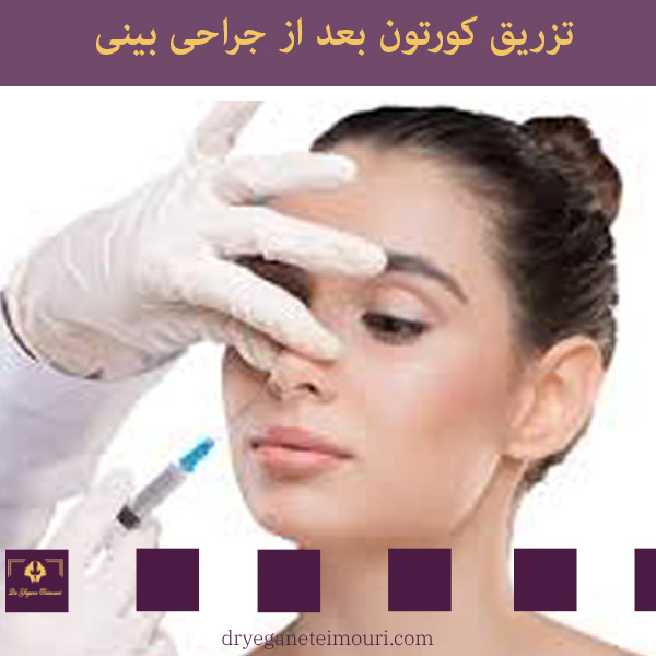 تزریق کورتون بعد از جراحی بینی