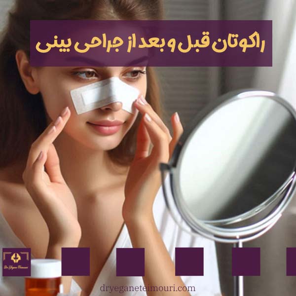 راکوتان قبل و بعد از جراحی بینی