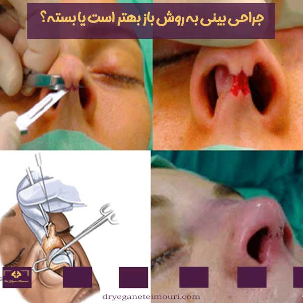 جراحی بینی به روش باز بهتر است یا بسته؟