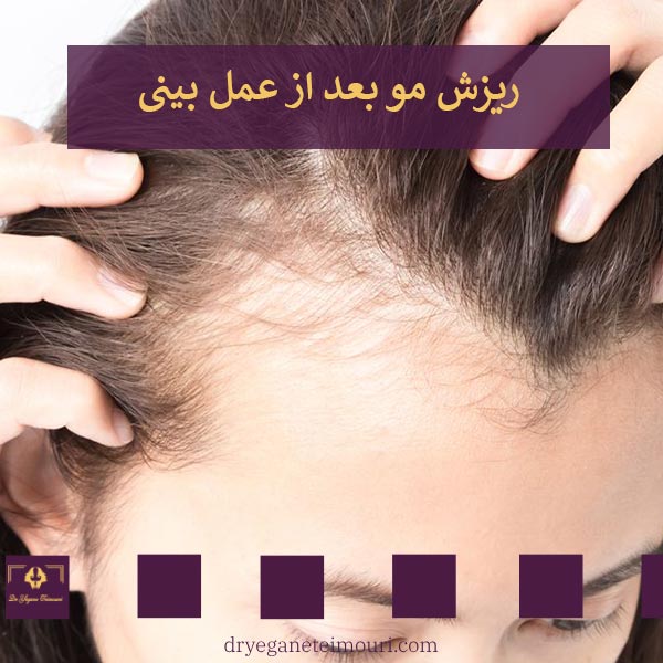 ریزش مو بعد از جراحی بینی _ دکتر یگانه تیموری
