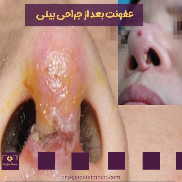 عفونت بعد از جراحی بینی