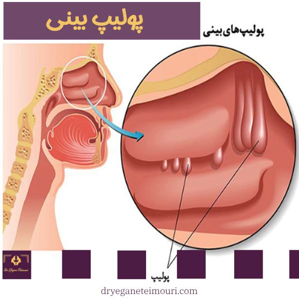 درمان پولیپ بینی _ دکتر یگانه تیموری