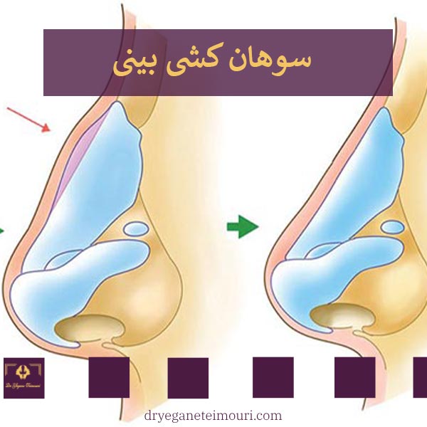 سوهان کشیدن بینی بعد از عمل _ دکتر یگانه تیموری
