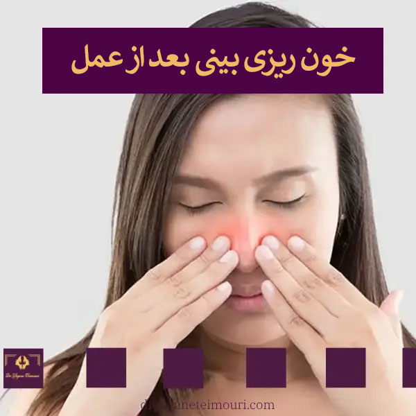 خون ریزی بینی بعد از عمل _ دکتر یگانه تیموری